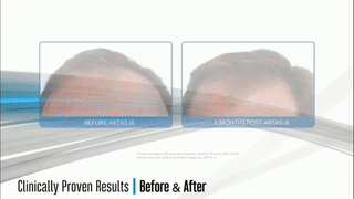 你的脫發有救了！搭載ARTAS系統的KUKA機器人將成為你的植發醫生